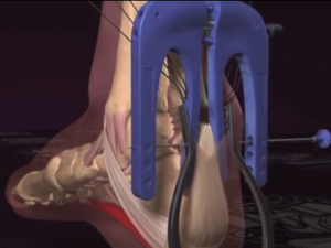 アキレス腱断裂縫合手術イメージ
