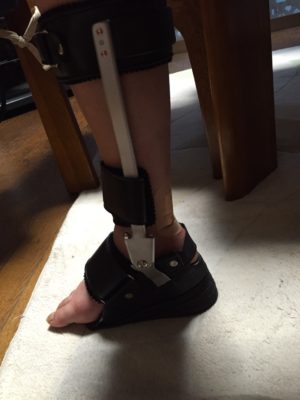 pippiさん［女性、55歳、千葉県、手術］のアキレス腱断裂用装具