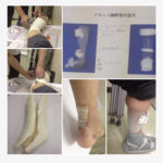 もとやんさん［男性、55歳、東京都、手術］のアキレス腱断裂用装具