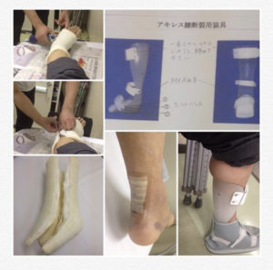 もとやんさん［男性、55歳、東京都、手術］のアキレス腱断裂用装具