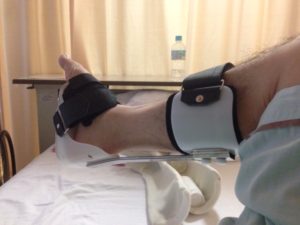 セイシュウさん［男性、62歳、北海道、手術］のアキレス腱断裂用装具
