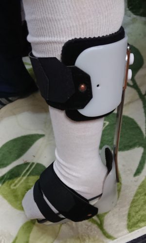 イノさん［女性、45歳、東京都、手術］のアキレス腱断裂用装具